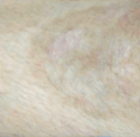 After treatment improved eczema skin condition