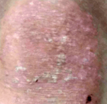 Before treatment eczema skin condition